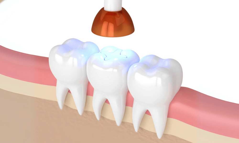 Composite Fillings Cost and Pricing Information in Pearland