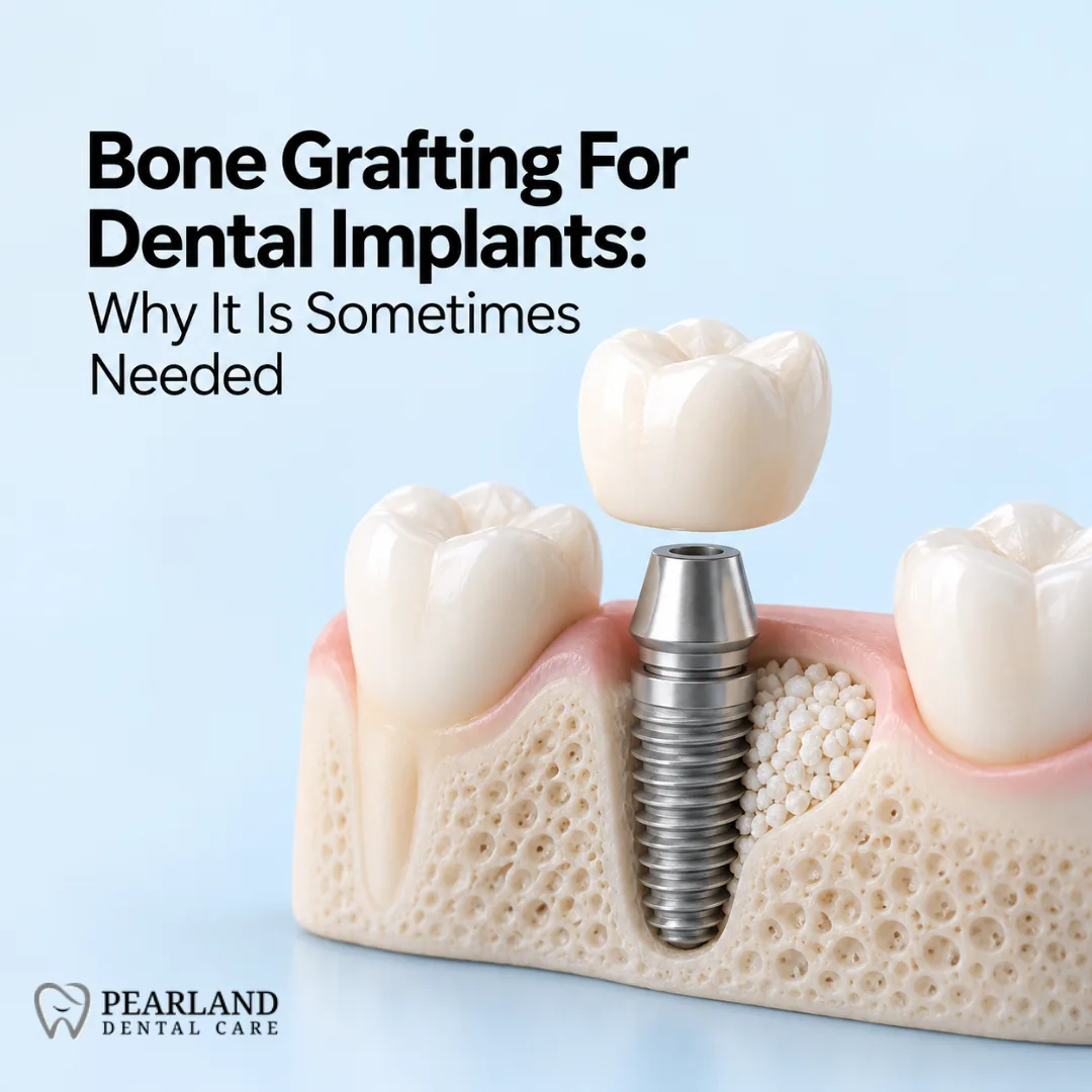 Bone Grafting For Dental Implants: Why It Is Sometimes Needed