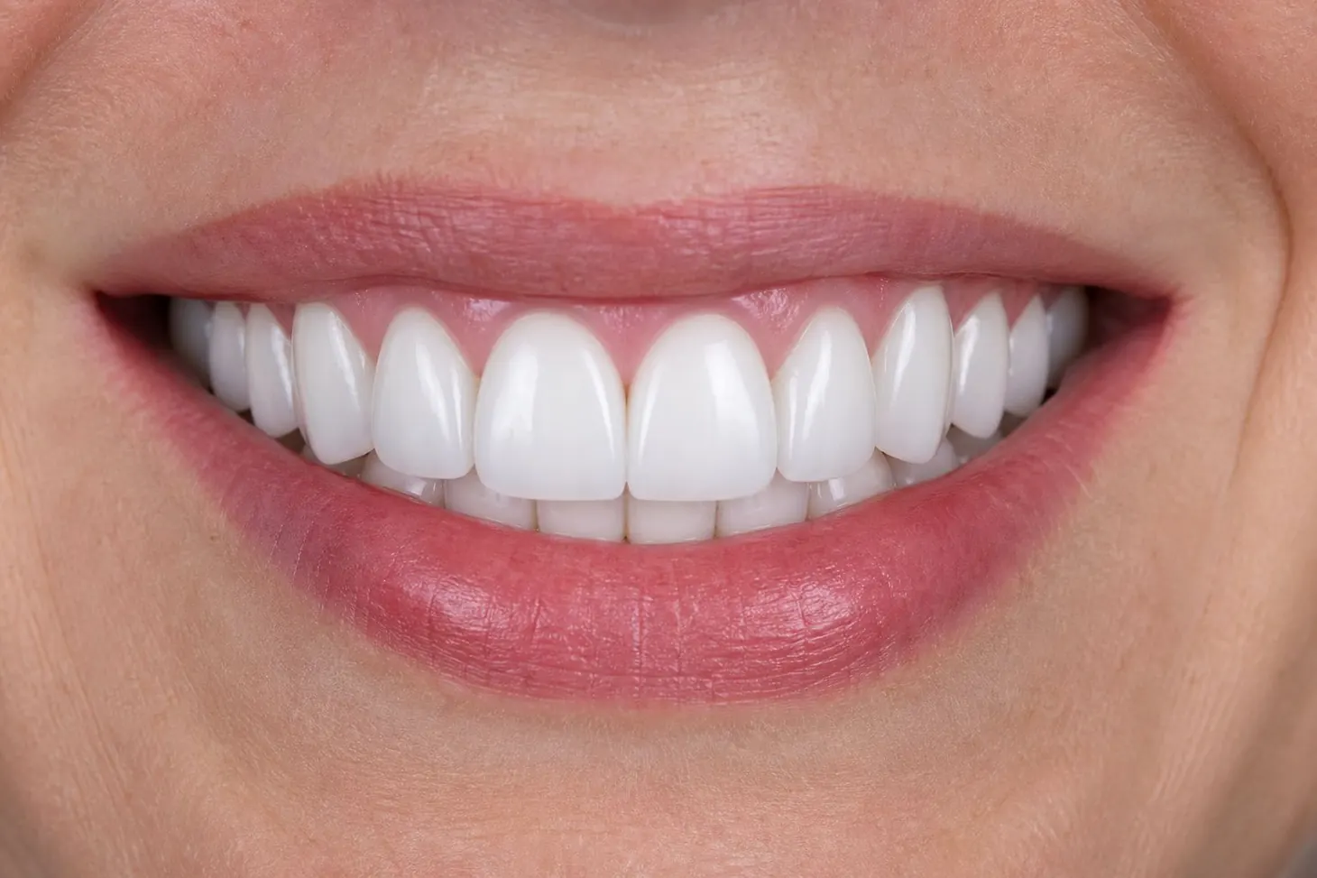 Full Smile Restoration — after treatment