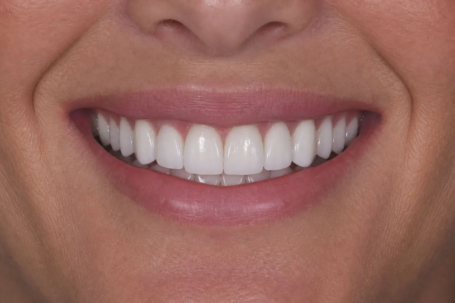 Cosmetic Smile Makeover — after treatment