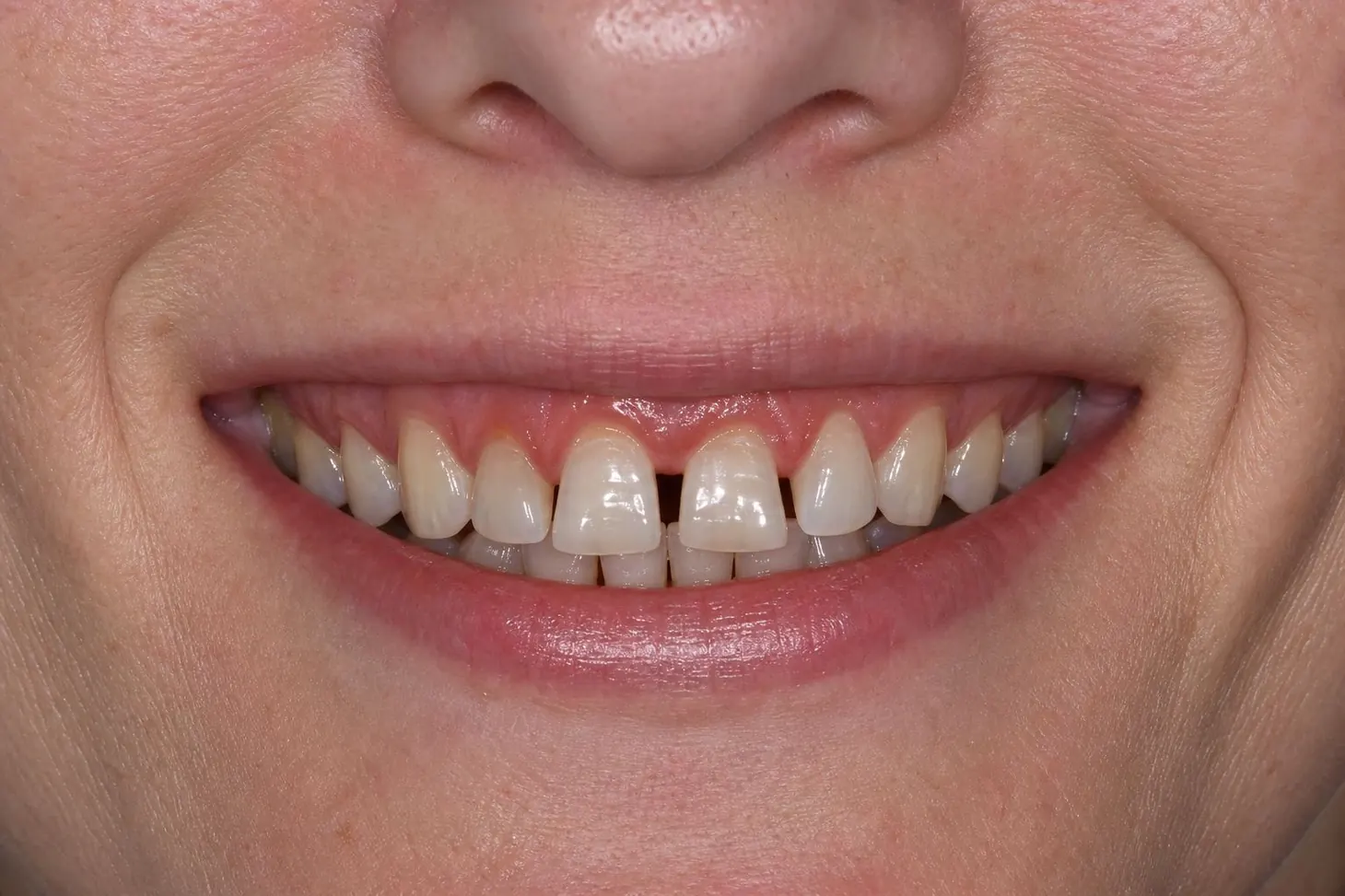 Cosmetic Smile Makeover — before treatment