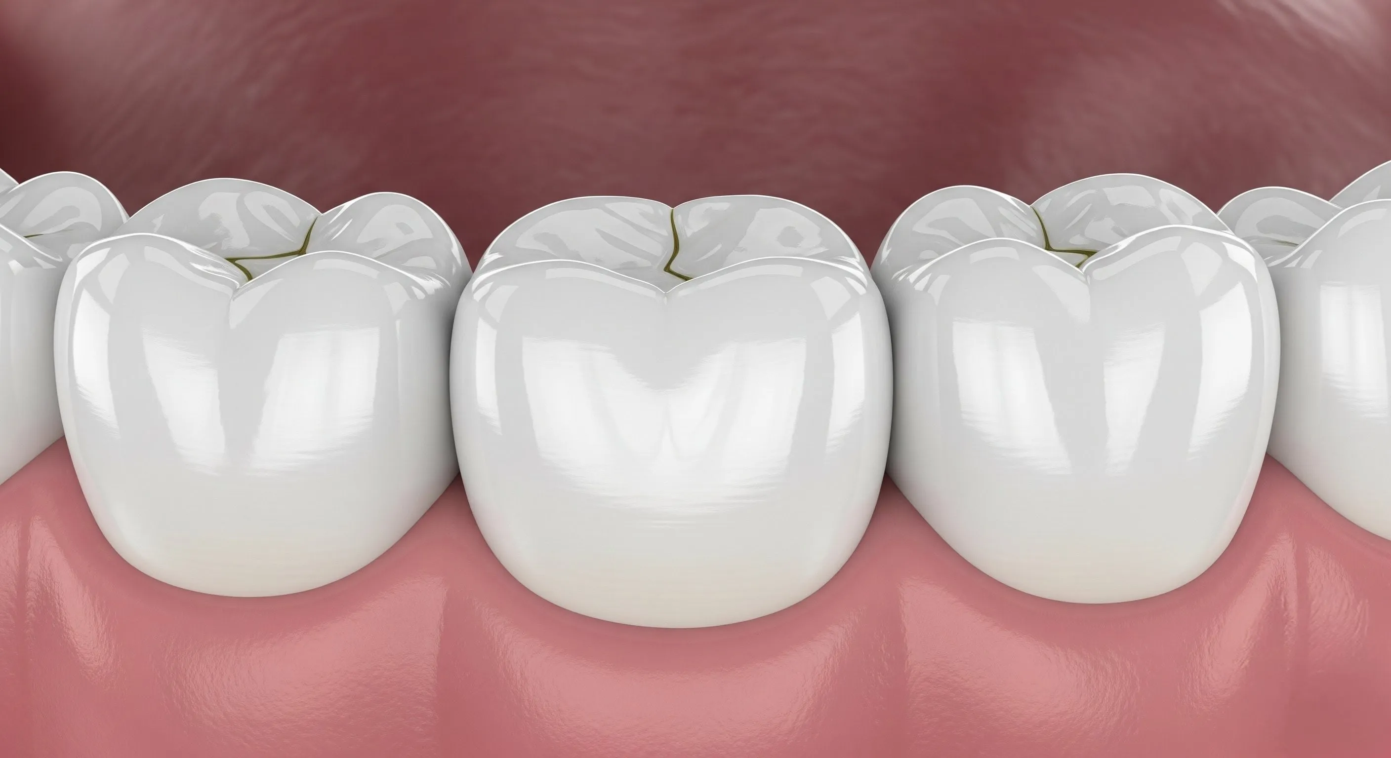 Composite Fillings at Pearland Dental Care, Pearland TX