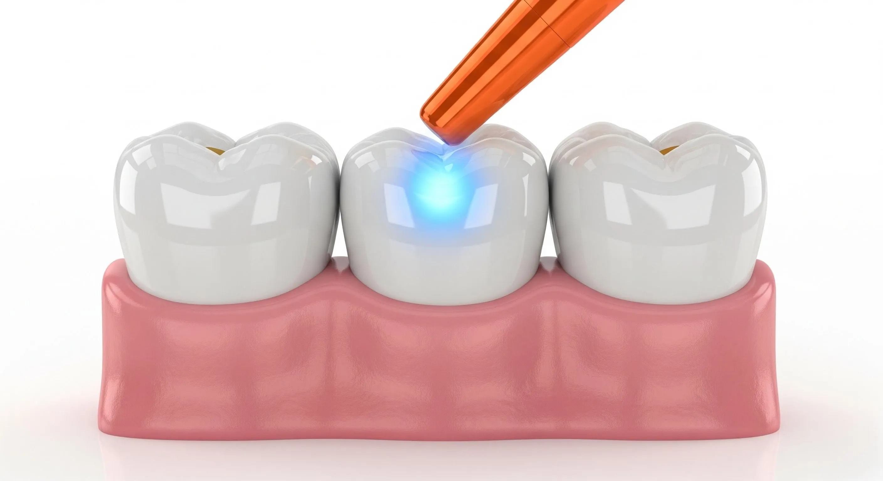 Composite Fillings Cost and Pricing Information in Pearland