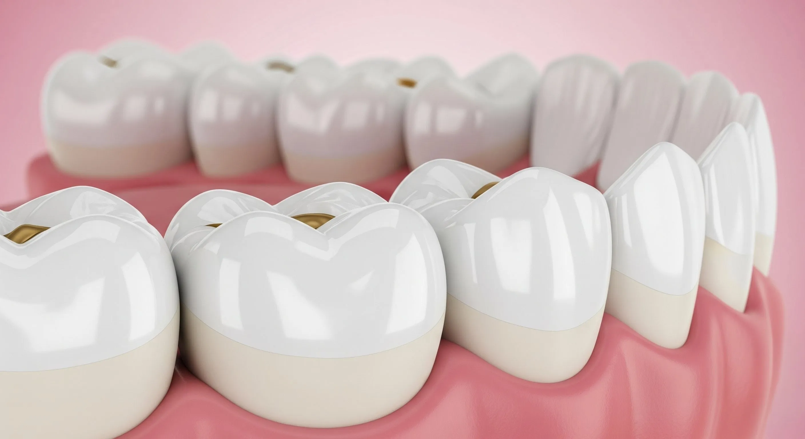 Dental Sealants at Pearland Dental Care, Pearland TX