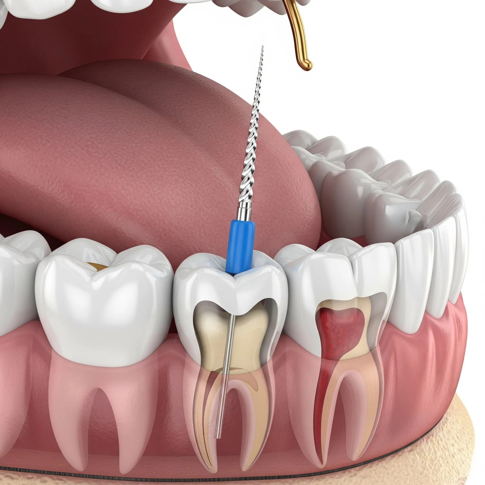 Endodontics at Pearland Dental Care, Pearland TX