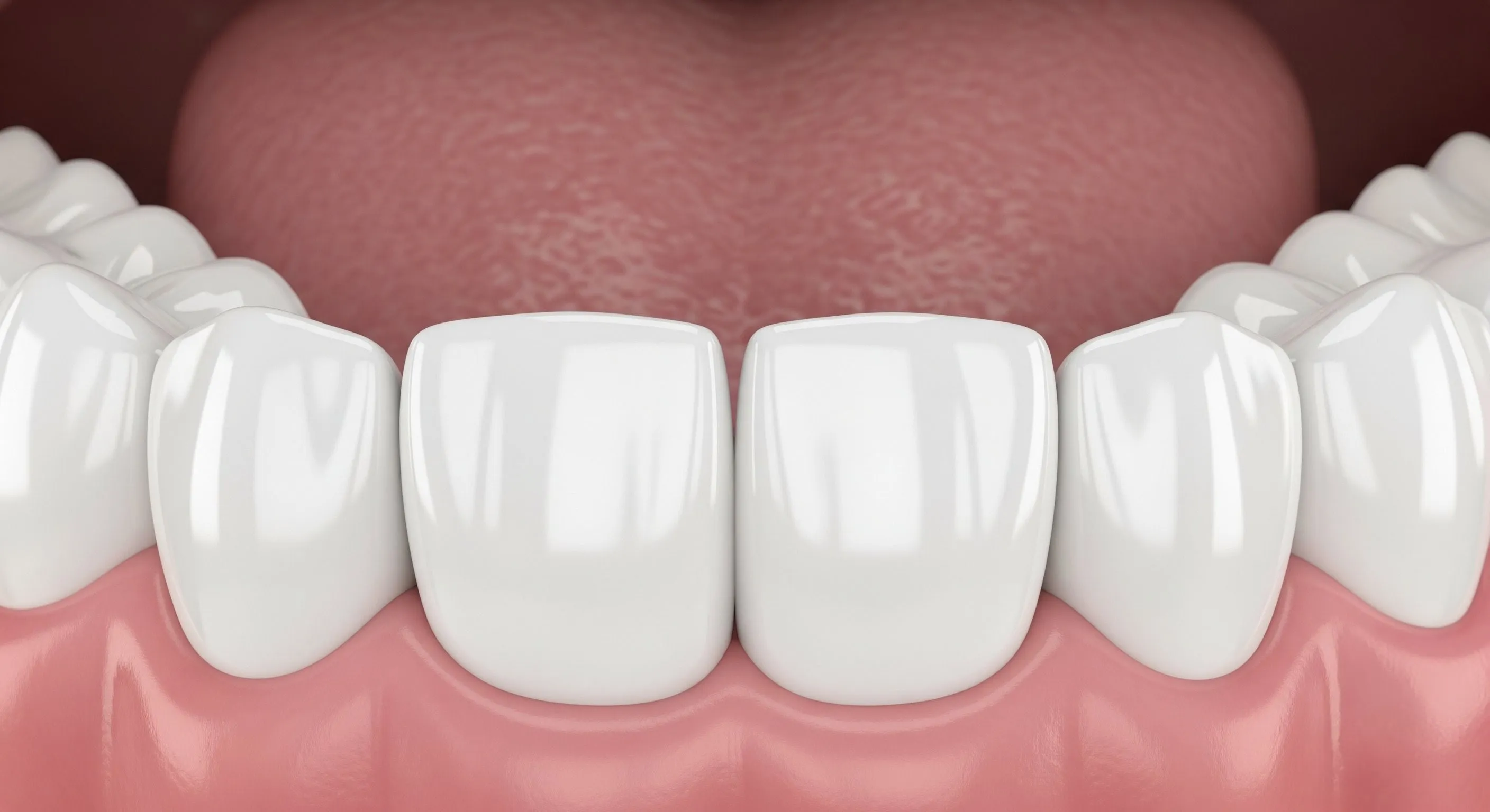 Fillings at Pearland Dental Care, Pearland TX