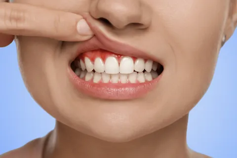 Gingivitis at Pearland Dental Care, Pearland TX