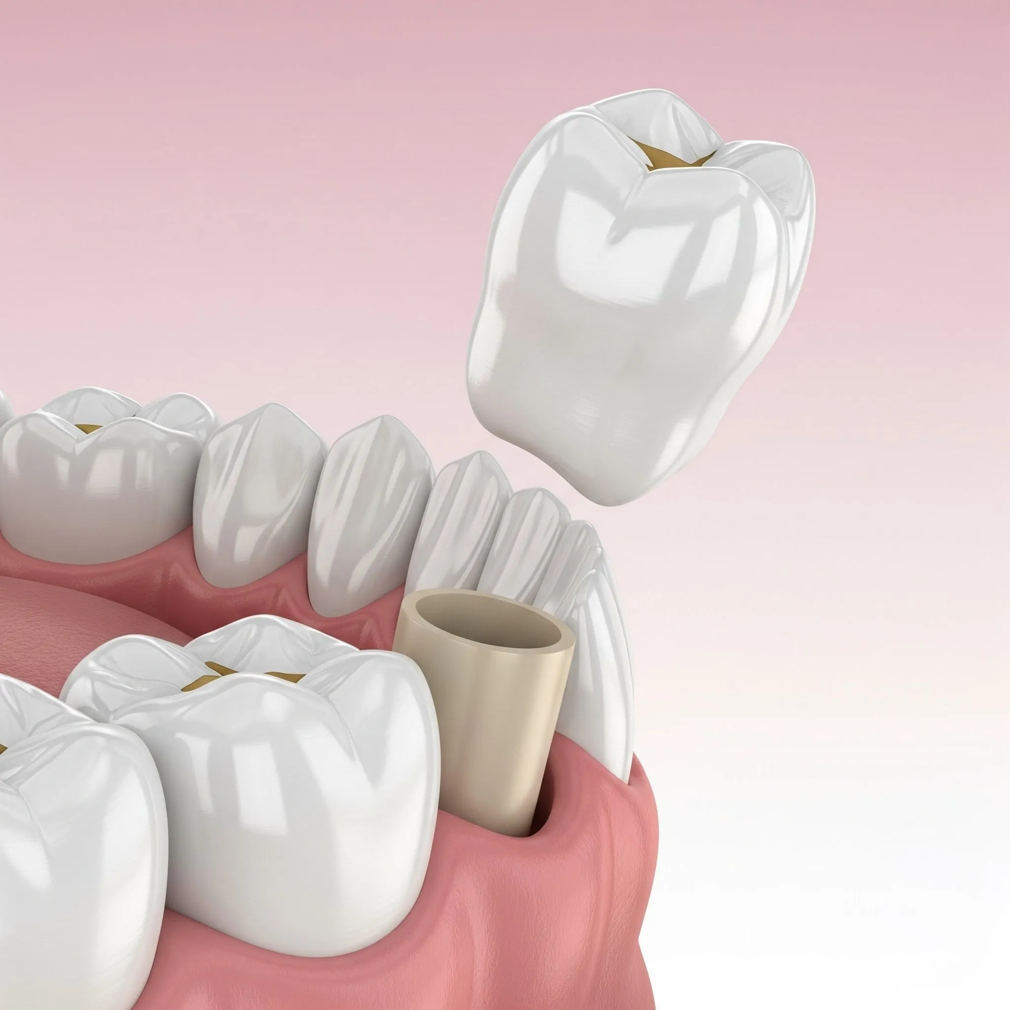 Prosthodontics at Pearland Dental Care, Pearland TX