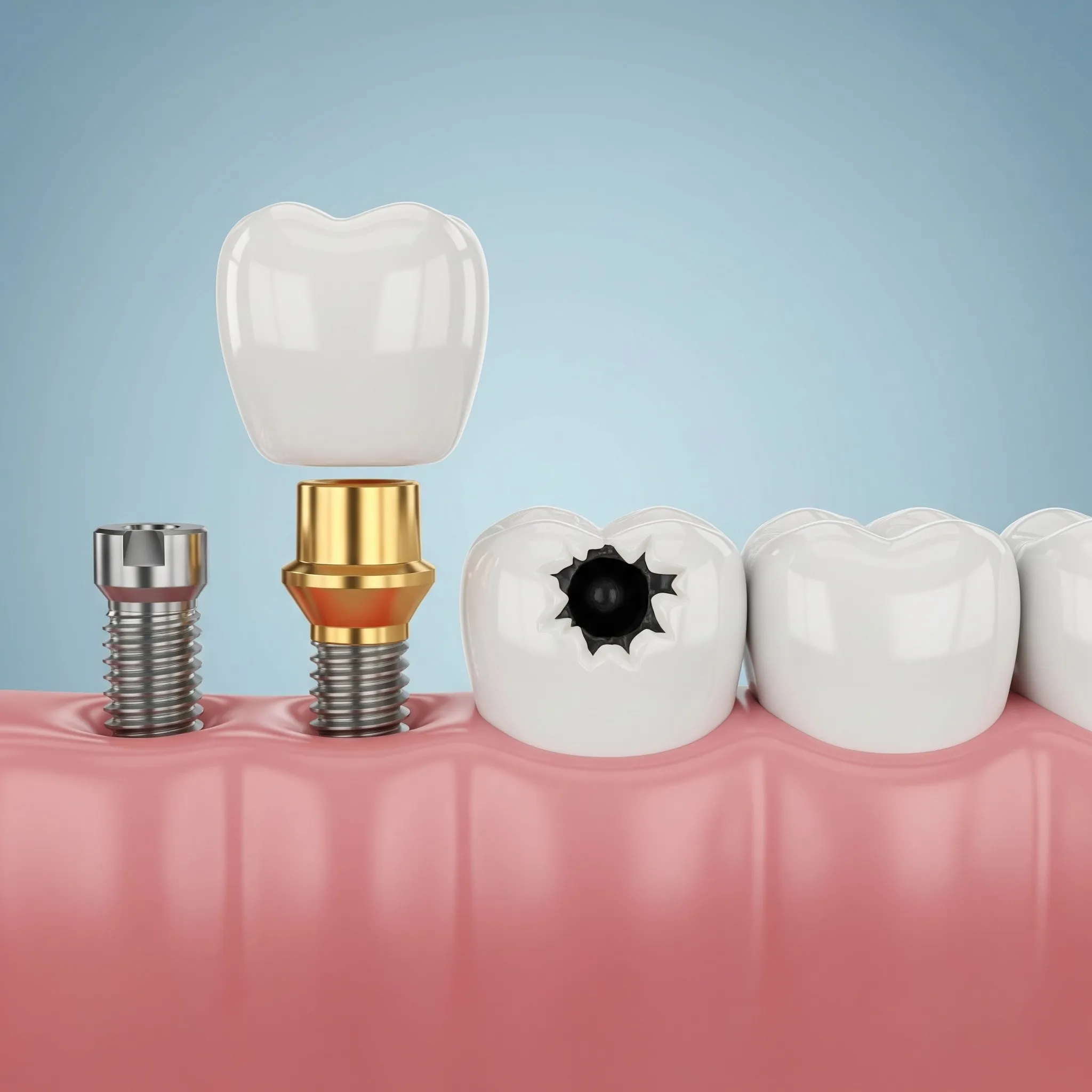 Restorative Dentistry at Pearland Dental Care, Pearland TX