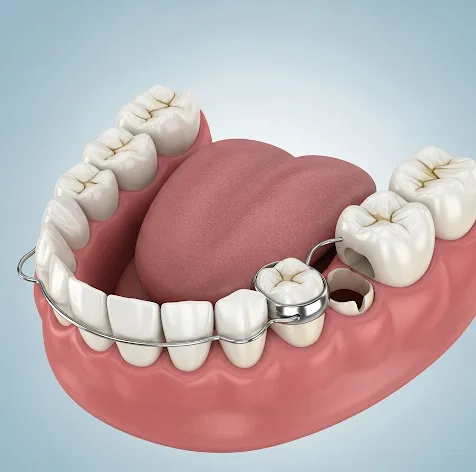 Space Maintainers at Pearland Dental Care, Pearland TX